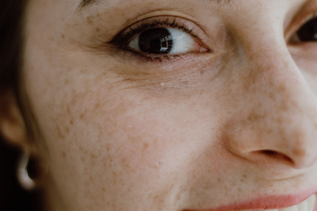 crows feet